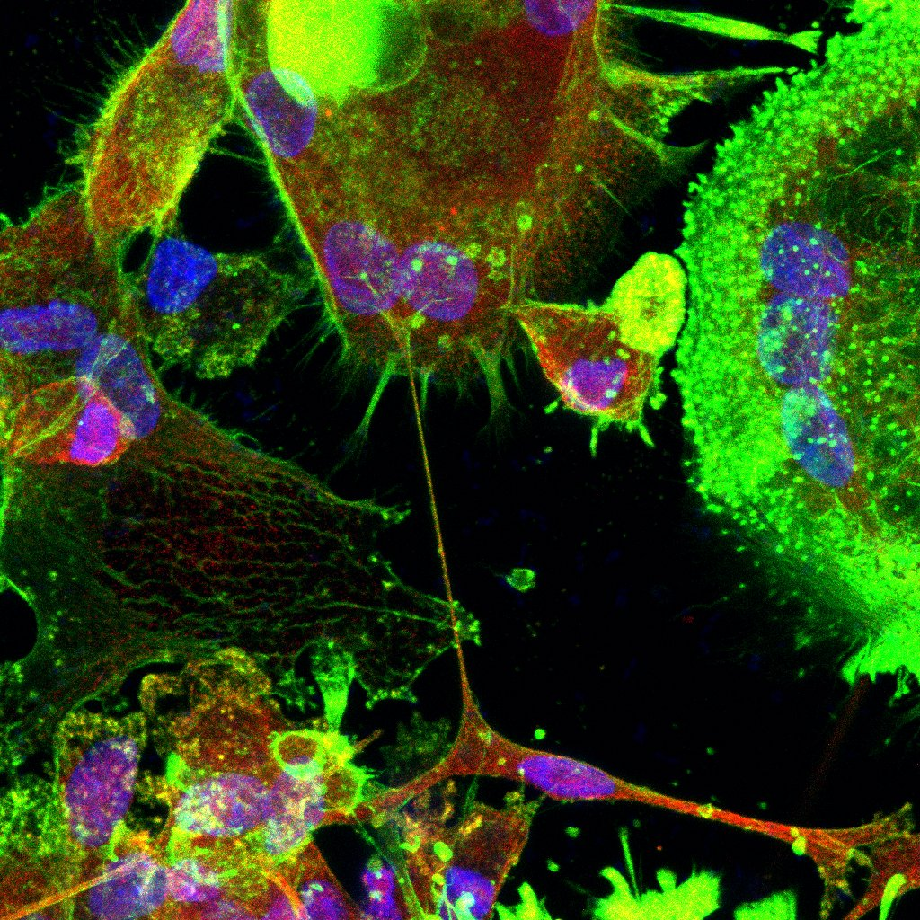 Tunneling nanotube (TNT) between iPSC-derived microglia from Alzheimer's disease patient